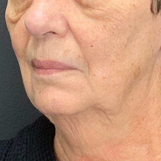 Laser Skin Resurfacing Before & After Image