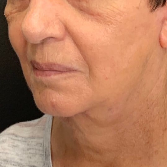 Laser Skin Resurfacing Before & After Image