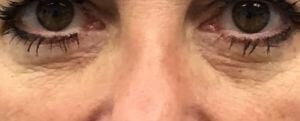 Rf Microneedling Before & After Image
