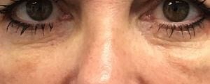 Rf Microneedling Before & After Image