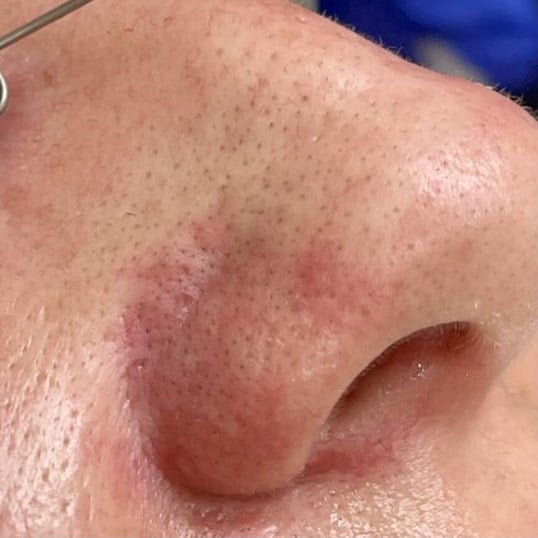 Vein Treatments Before & After Image