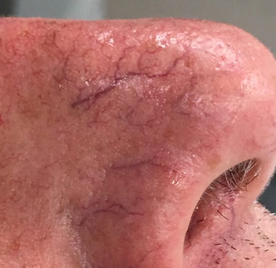 Vein Treatments Before & After Image