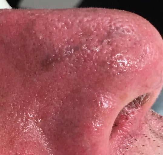 Vein Treatments Before & After Image
