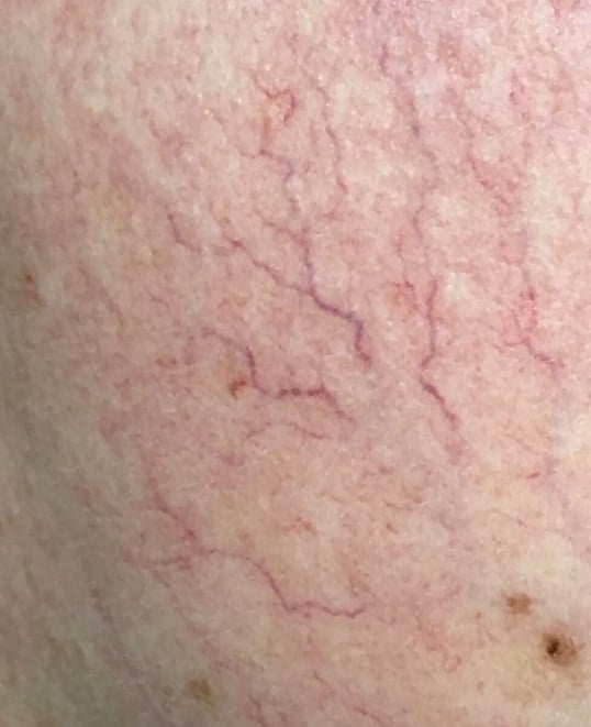 Vein Treatments Before & After Image