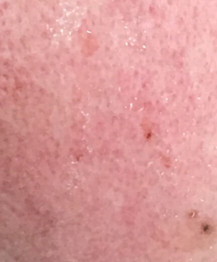 Vein Treatments Before & After Image
