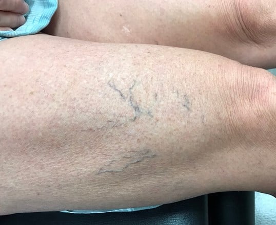 Vein Treatments Before & After Image