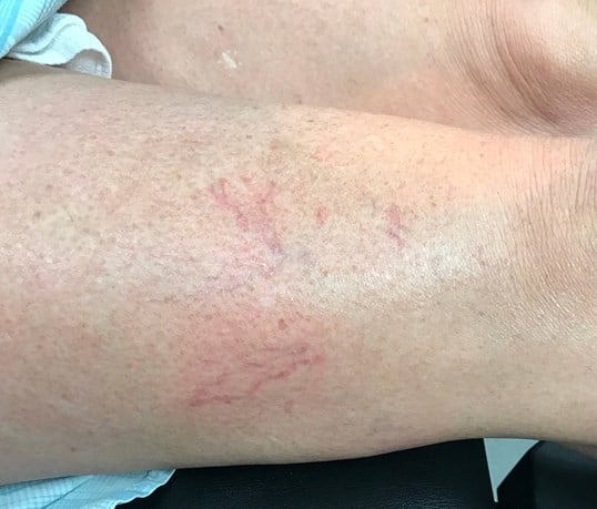 Vein Treatments Before & After Image