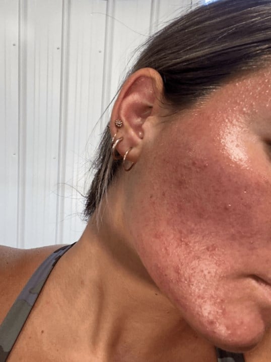 HydraFacial Before & After Image