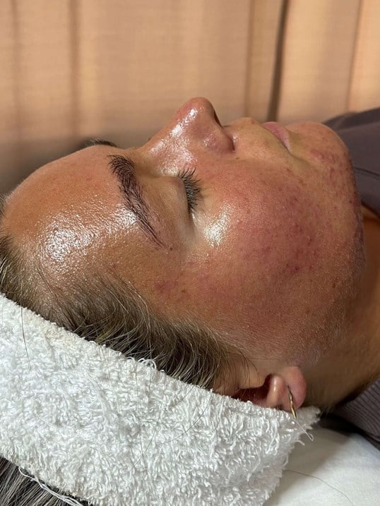 HydraFacial Before & After Image
