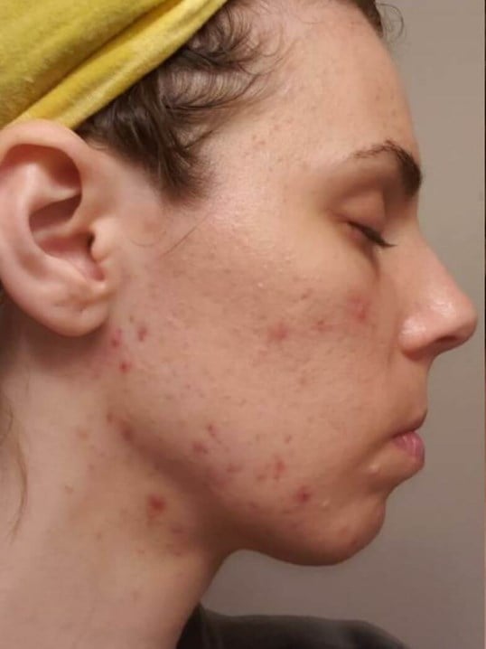 HydraFacial Before & After Image