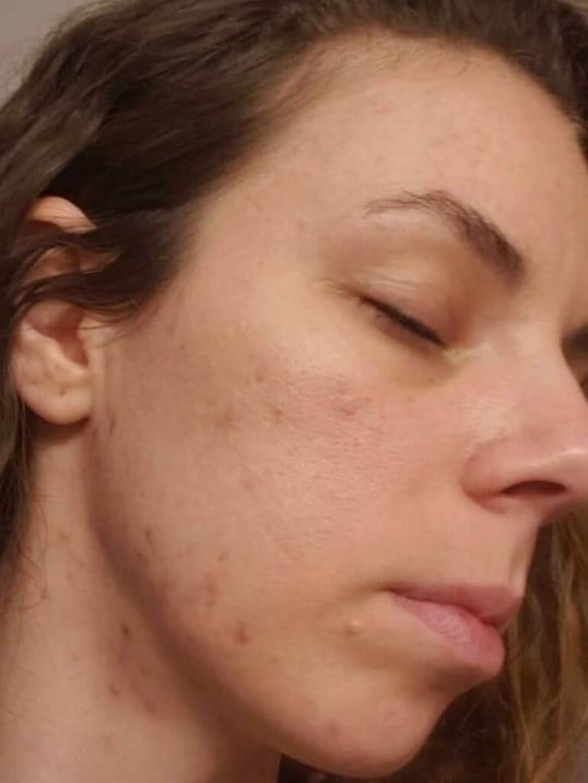 HydraFacial Before & After Image