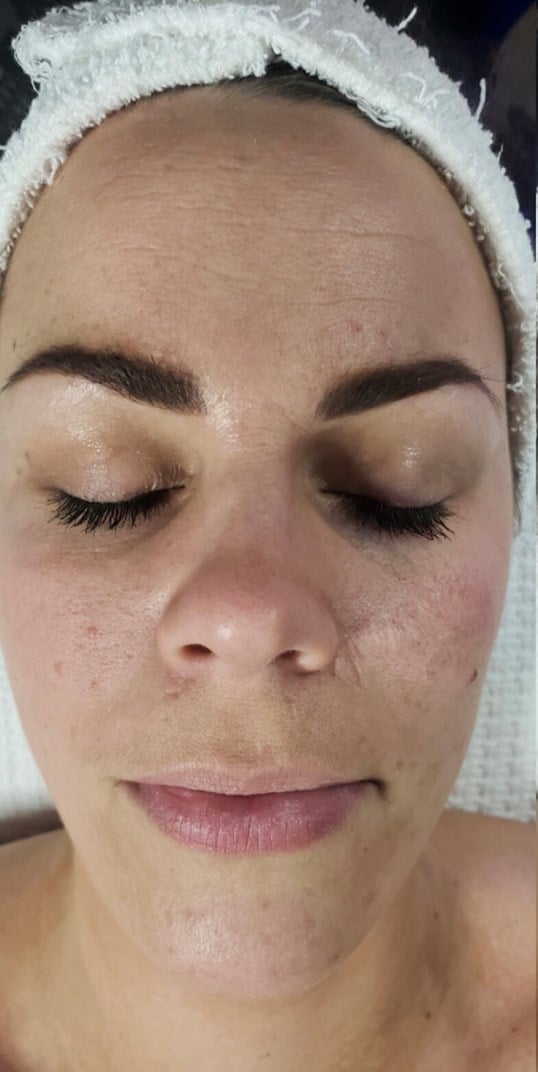HydraFacial Before & After Image