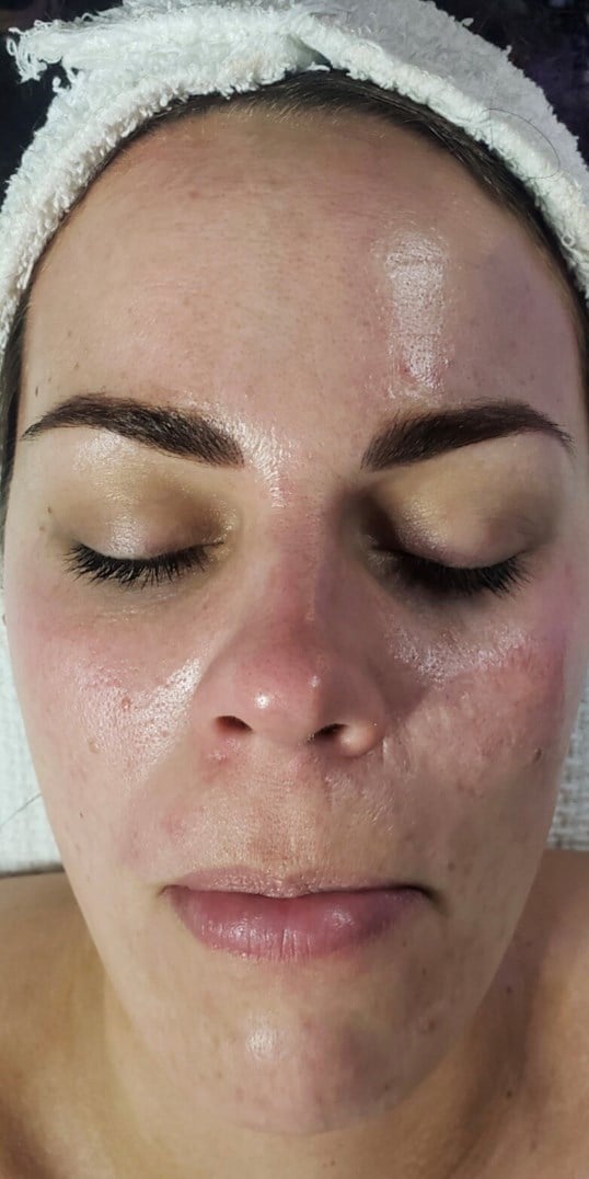 HydraFacial Before & After Image