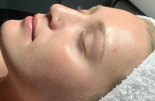 HydraFacial Before & After Image