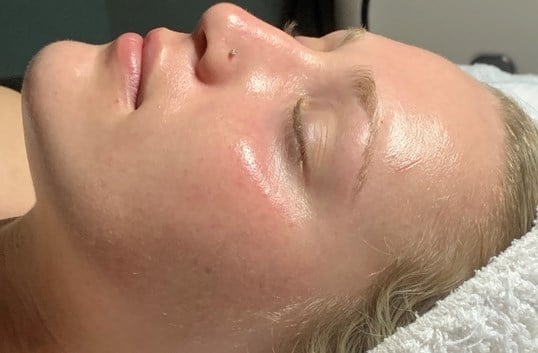 HydraFacial Before & After Image