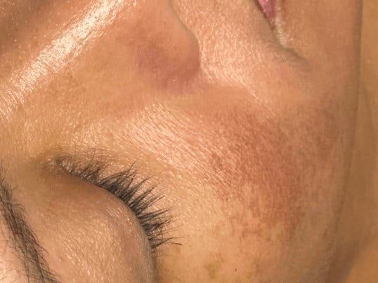 Jetpeel Pro Before & After Image