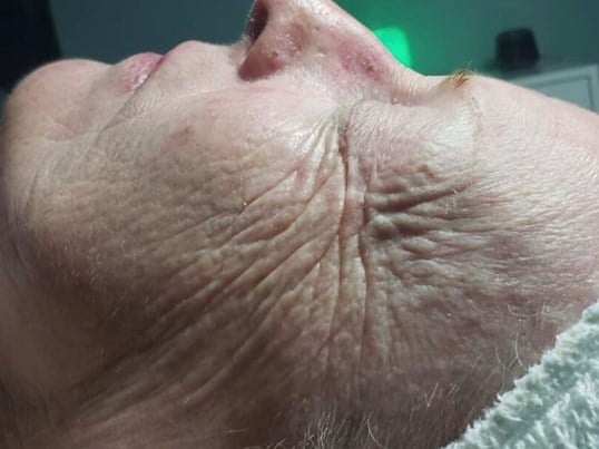 Jetpeel Pro Before & After Image